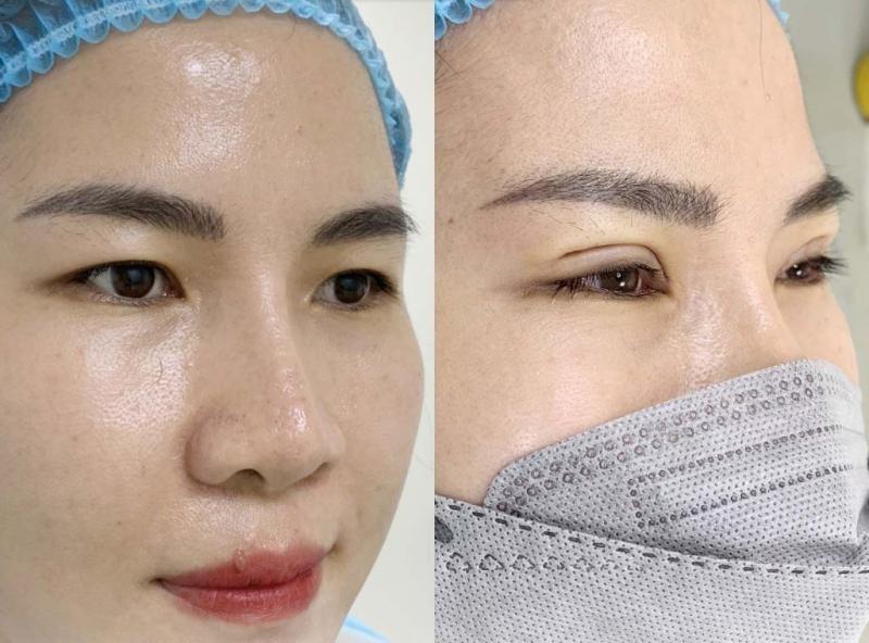 Cắt, nhấn mí mắt tại Daisy Spa & Beauty